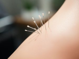 Acupunctura pentru dureri cronice: ace fine în piele.
